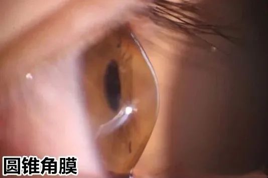 圆锥角膜最新治疗，小巷深处的秘密小店探索